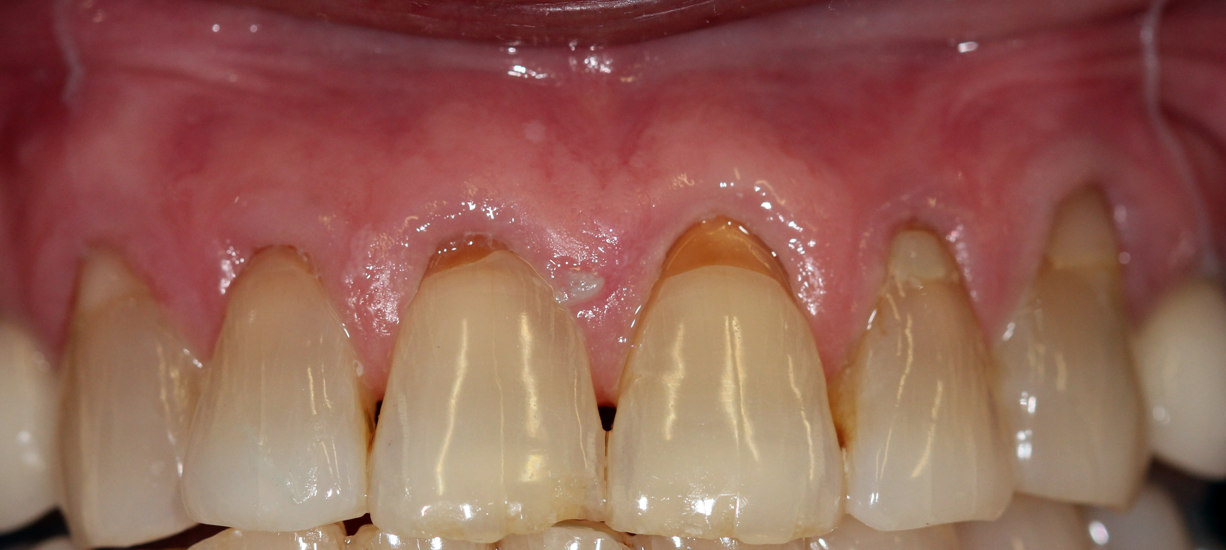 upper anterior teeth  before surgery